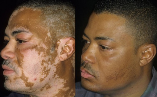 vitiligo